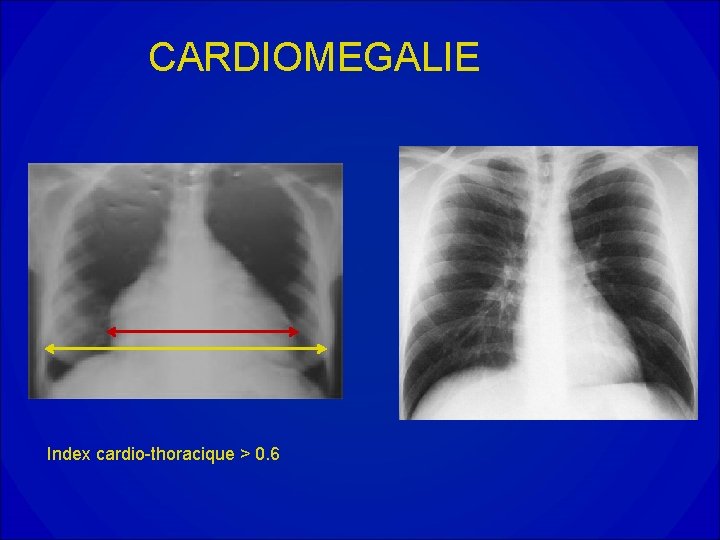 CARDIOMEGALIE Index cardio-thoracique > 0. 6 CARDIOMEGALIE Index cardio-thoracique > 0. 6