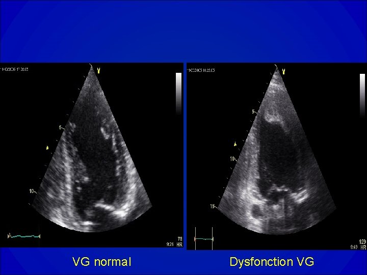 VG normal Dysfonction VG 