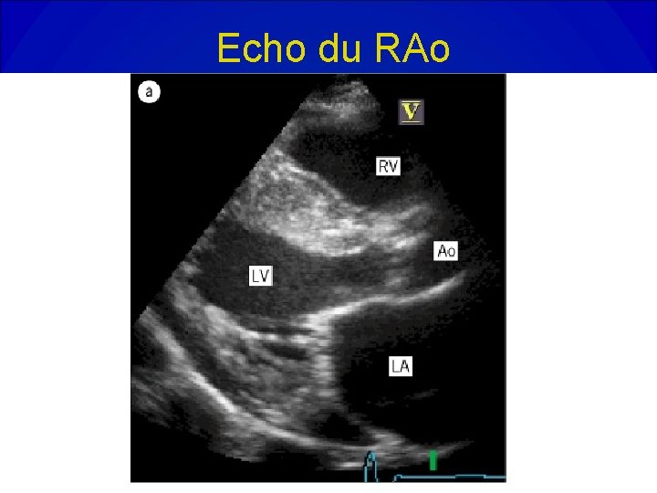 Echo du RAo Echo du RAo