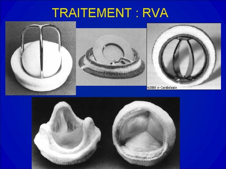 TRAITEMENT : RVA 