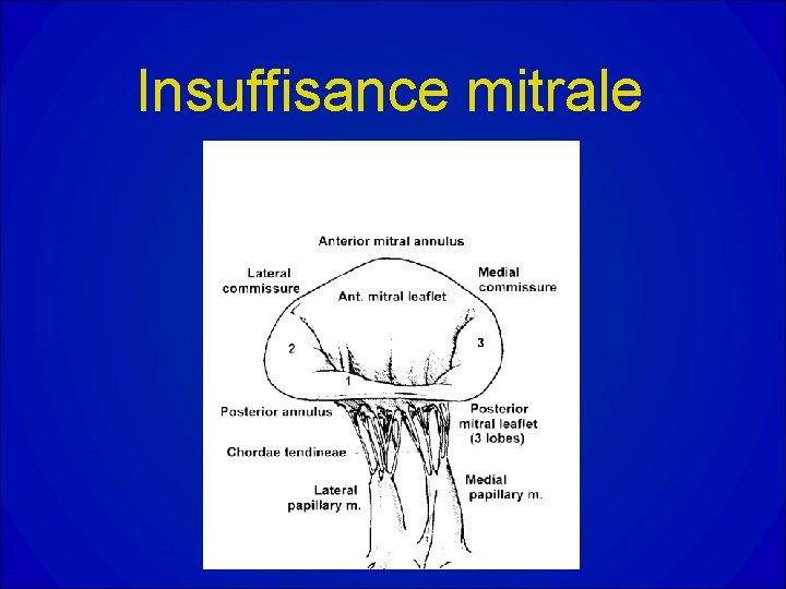 Insuffisance mitrale Insuffisance mitrale