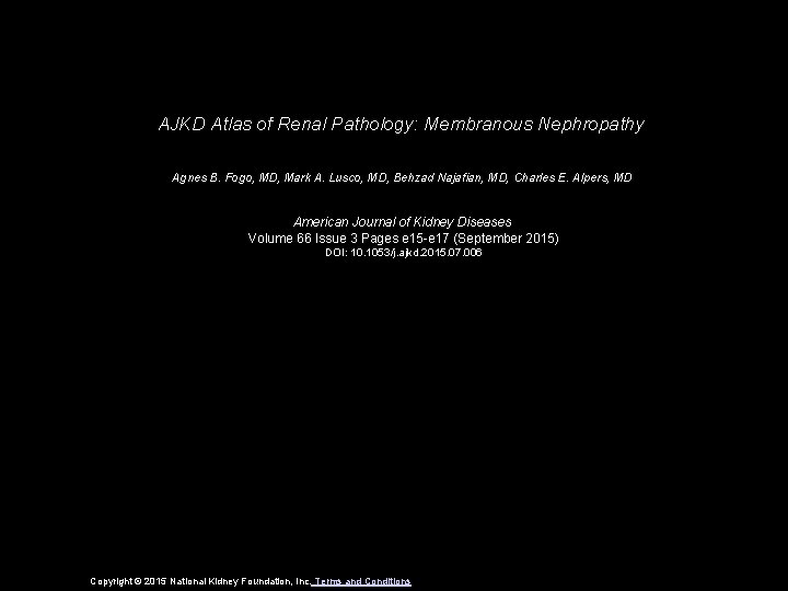 AJKD Atlas of Renal Pathology: Membranous Nephropathy Agnes B. Fogo, MD, Mark A. Lusco,