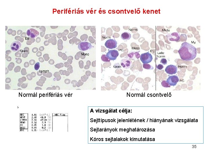Perifériás vér és csontvelő kenet Normál perifériás vér Normál csontvelő A vizsgálat célja: Sejttípusok