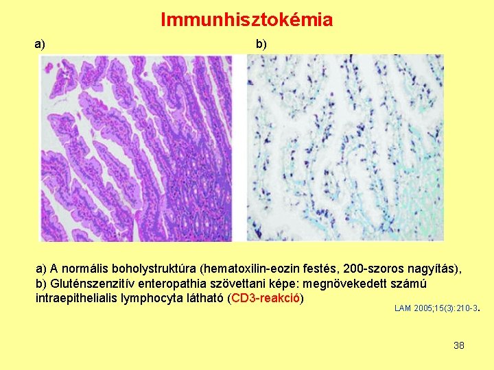 Immunhisztokémia a) b) a) A normális boholystruktúra (hematoxilin-eozin festés, 200 -szoros nagyítás), b) Gluténszenzitív