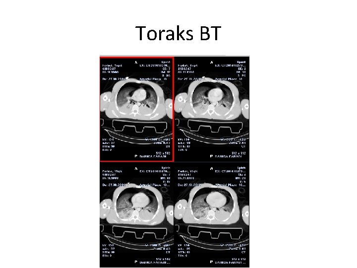 Toraks BT 