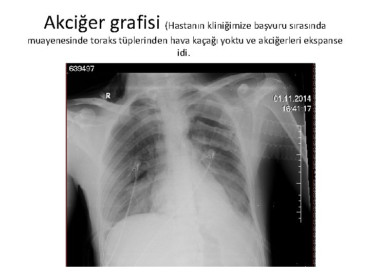 Akciğer grafisi (Hastanın kliniğimize başvuru sırasında muayenesinde toraks tüplerinden hava kaçağı yoktu ve akciğerleri