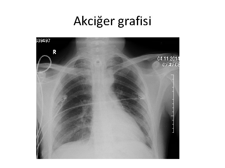 Akciğer grafisi 