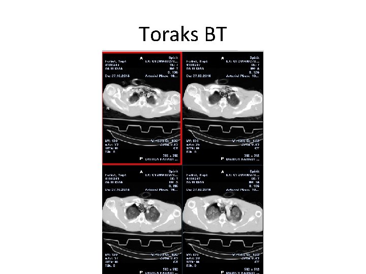 Toraks BT 