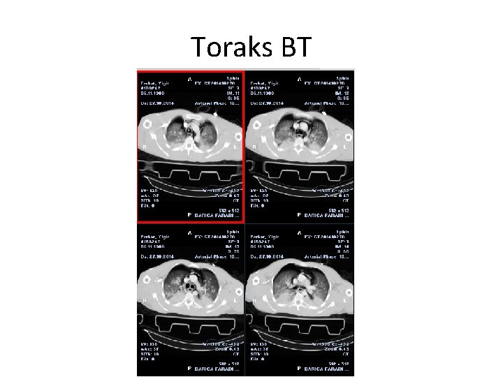 Toraks BT 