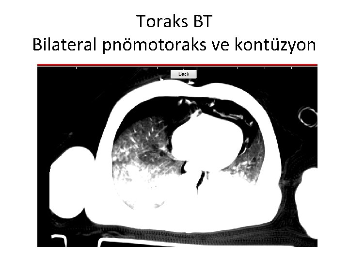 Toraks BT Bilateral pnömotoraks ve kontüzyon 