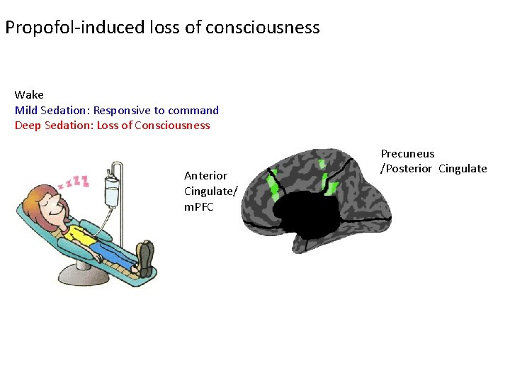 Propofol-induced loss of consciousness Wake Mild Sedation: Responsive to command Deep Sedation: Loss of Propofol-induced loss of consciousness Wake Mild Sedation: Responsive to command Deep Sedation: Loss of