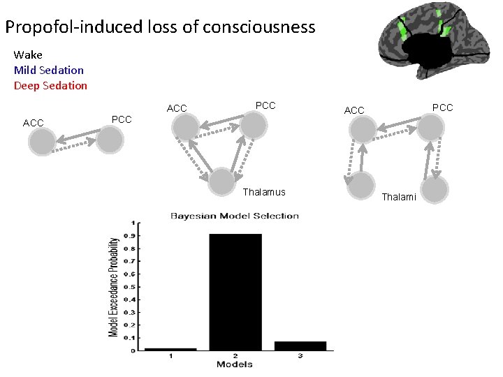 Propofol-induced loss of consciousness Wake Mild Sedation Deep Sedation ACC PCC Thalamus PCC ACC Propofol-induced loss of consciousness Wake Mild Sedation Deep Sedation ACC PCC Thalamus PCC ACC
