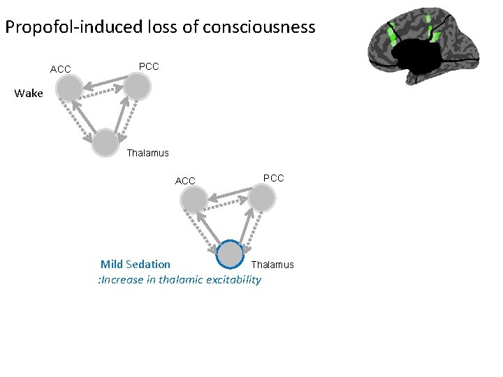 Propofol-induced loss of consciousness ACC PCC Wake Thalamus ACC PCC Thalamus Mild Sedation : Propofol-induced loss of consciousness ACC PCC Wake Thalamus ACC PCC Thalamus Mild Sedation :