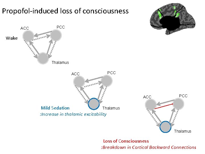 Propofol-induced loss of consciousness ACC PCC Wake Thalamus ACC PCC Thalamus Mild Sedation : Propofol-induced loss of consciousness ACC PCC Wake Thalamus ACC PCC Thalamus Mild Sedation :