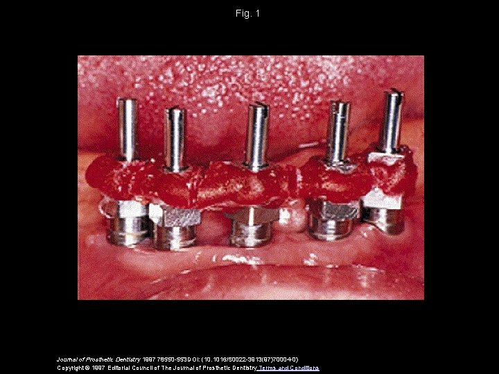 Fig. 1 Journal of Prosthetic Dentistry 1997 78550 -553 DOI: (10. 1016/S 0022 -3913(97)70004