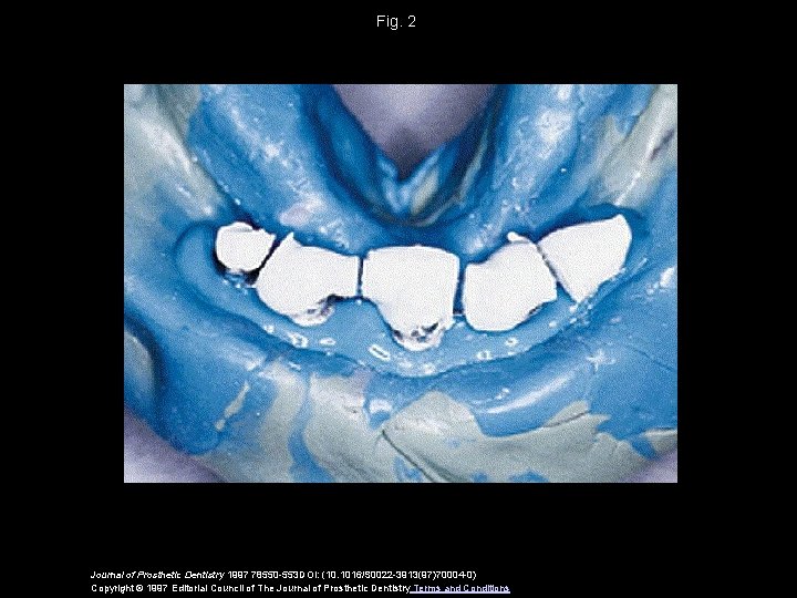 Fig. 2 Journal of Prosthetic Dentistry 1997 78550 -553 DOI: (10. 1016/S 0022 -3913(97)70004