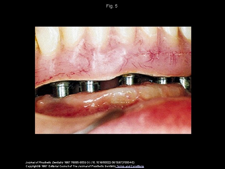 Fig. 5 Journal of Prosthetic Dentistry 1997 78550 -553 DOI: (10. 1016/S 0022 -3913(97)70004