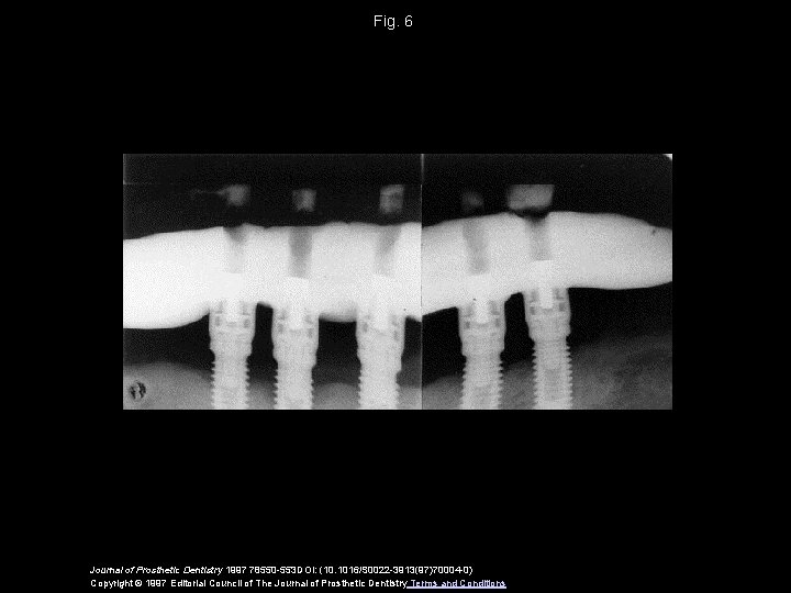 Fig. 6 Journal of Prosthetic Dentistry 1997 78550 -553 DOI: (10. 1016/S 0022 -3913(97)70004