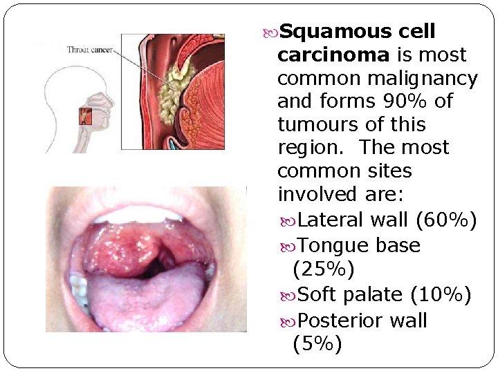Squamous cell carcinoma is most common malignancy and forms 90% of tumours of Squamous cell carcinoma is most common malignancy and forms 90% of tumours of