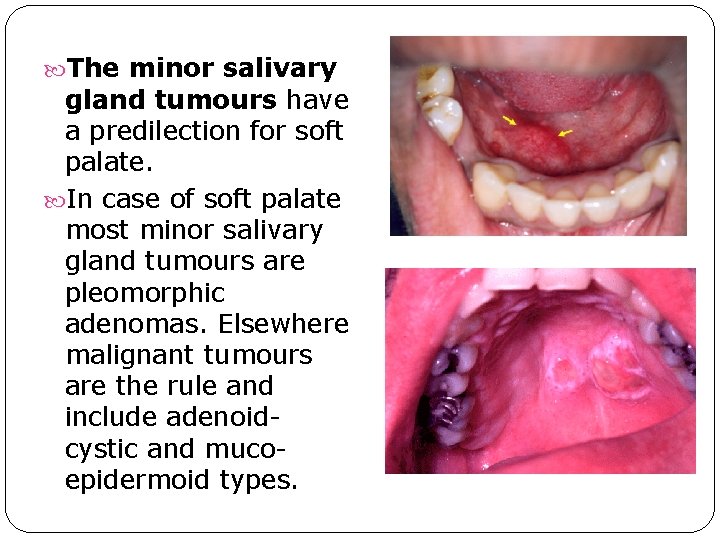 The minor salivary gland tumours have a predilection for soft palate. In case The minor salivary gland tumours have a predilection for soft palate. In case