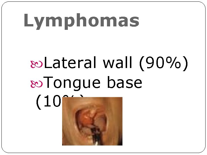 Lymphomas Lateral wall (90%) Tongue base (10%) Lymphomas Lateral wall (90%) Tongue base (10%)