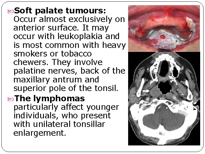 Soft palate tumours: Occur almost exclusively on anterior surface. It may occur with Soft palate tumours: Occur almost exclusively on anterior surface. It may occur with