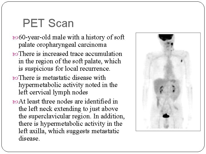 PET Scan 60 -year-old male with a history of soft palate oropharyngeal carcinoma There PET Scan 60 -year-old male with a history of soft palate oropharyngeal carcinoma There