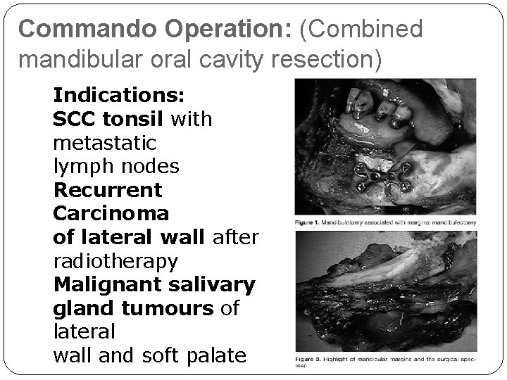 Commando Operation: (Combined mandibular oral cavity resection) Indications: SCC tonsil with metastatic lymph nodes Commando Operation: (Combined mandibular oral cavity resection) Indications: SCC tonsil with metastatic lymph nodes