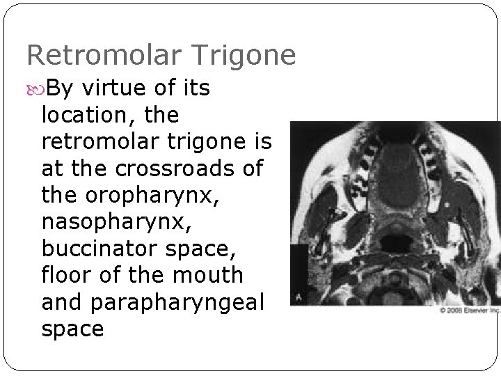 Retromolar Trigone By virtue of its location, the retromolar trigone is at the crossroads Retromolar Trigone By virtue of its location, the retromolar trigone is at the crossroads