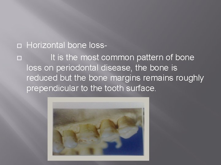  Horizontal bone loss. It is the most common pattern of bone loss on
