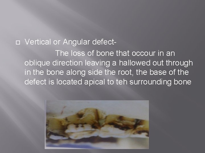  Vertical or Angular defect. The loss of bone that occour in an oblique