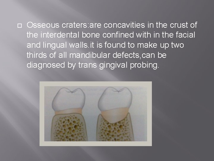  Osseous craters: are concavities in the crust of the interdental bone confined with