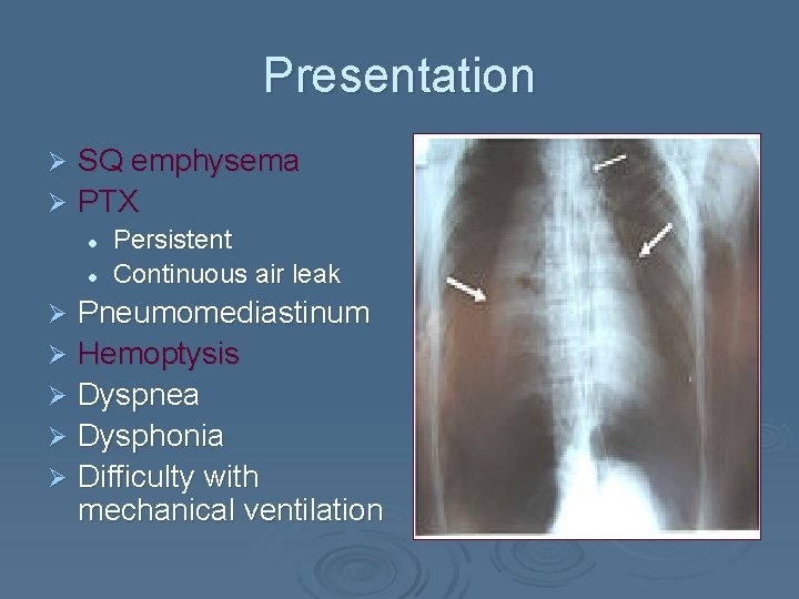 Presentation SQ emphysema Ø PTX Ø l l Persistent Continuous air leak Pneumomediastinum Ø