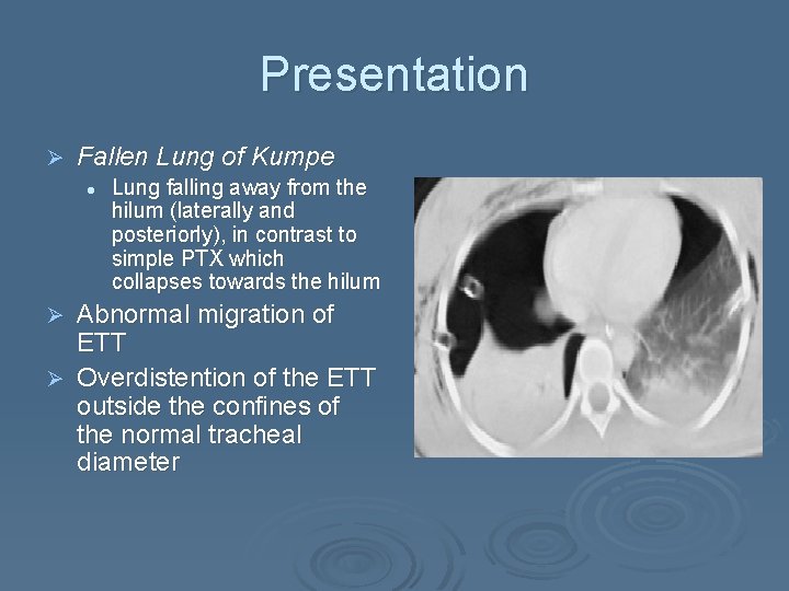 Presentation Ø Fallen Lung of Kumpe l Lung falling away from the hilum (laterally