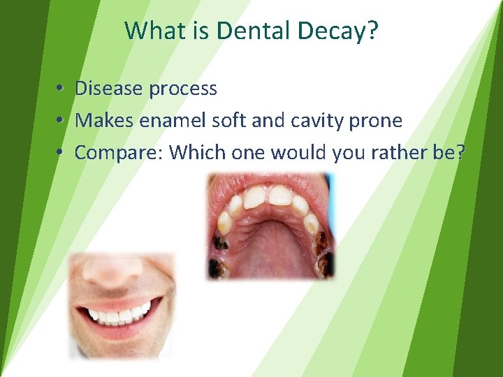 What is Dental Decay? • • • Disease process Makes enamel soft and cavity