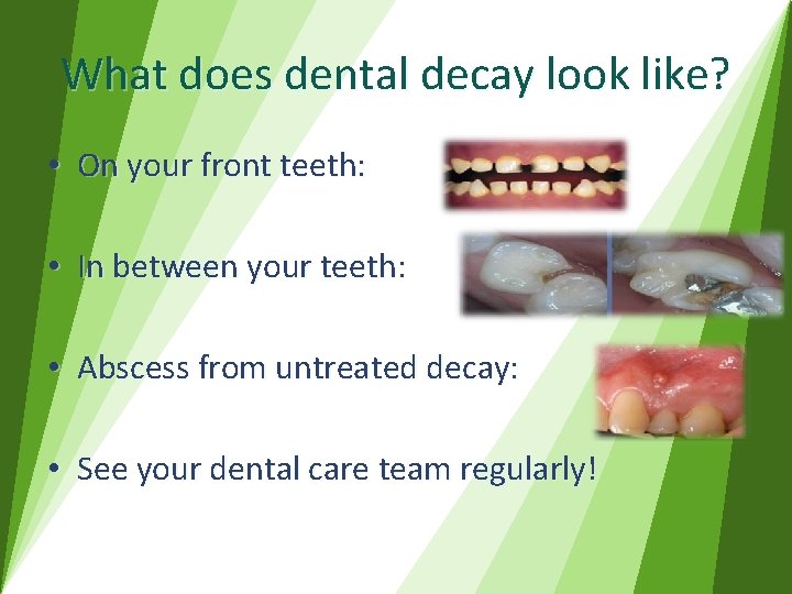 What does dental decay look like? • On your front teeth: • In between