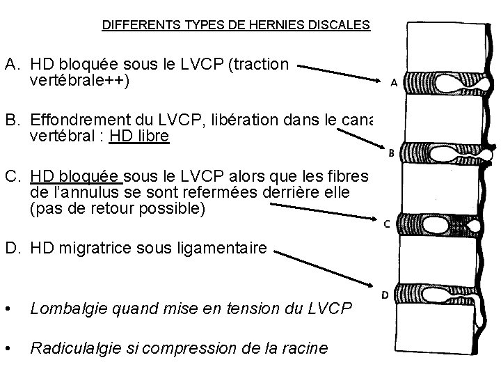 DIFFERENTS TYPES DE HERNIES DISCALES A. HD bloquée sous le LVCP (traction vertébrale++) B.