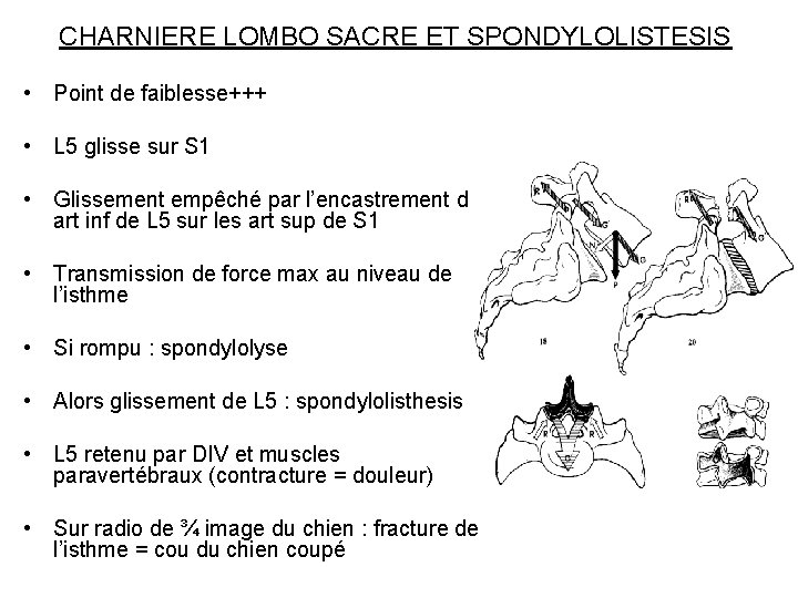 CHARNIERE LOMBO SACRE ET SPONDYLOLISTESIS • Point de faiblesse+++ • L 5 glisse sur