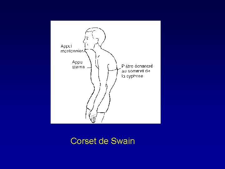 Corset de Swain 