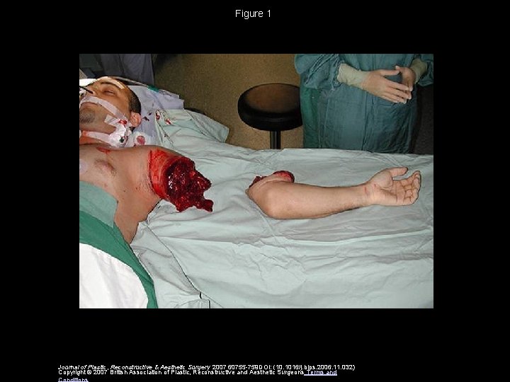 Figure 1 Journal of Plastic, Reconstructive & Aesthetic Surgery 2007 60755 -759 DOI: (10.