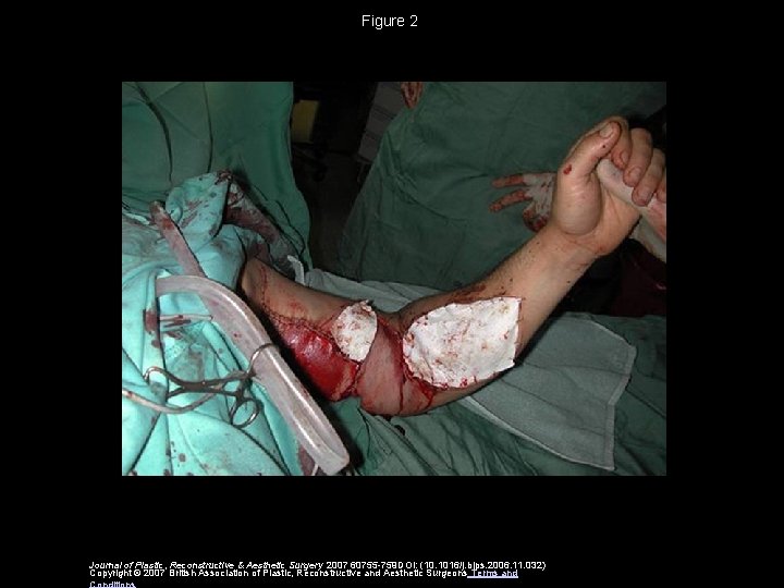 Figure 2 Journal of Plastic, Reconstructive & Aesthetic Surgery 2007 60755 -759 DOI: (10.
