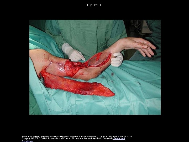 Figure 3 Journal of Plastic, Reconstructive & Aesthetic Surgery 2007 60755 -759 DOI: (10.