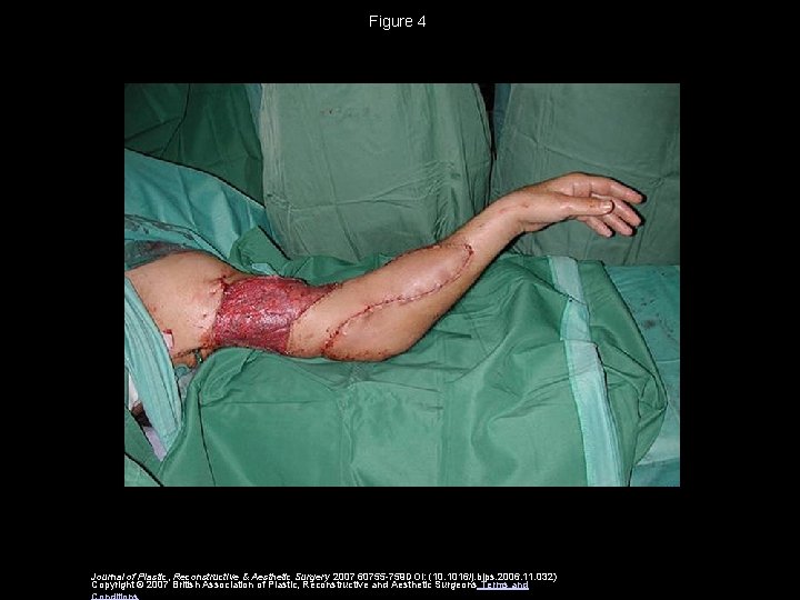 Figure 4 Journal of Plastic, Reconstructive & Aesthetic Surgery 2007 60755 -759 DOI: (10.