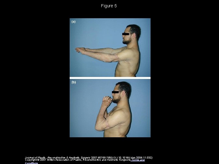 Figure 5 Journal of Plastic, Reconstructive & Aesthetic Surgery 2007 60755 -759 DOI: (10.