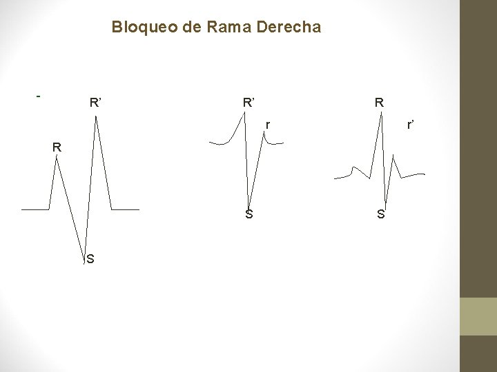 Bloqueo de Rama Derecha - R’ R’ R r r’ R S S S Bloqueo de Rama Derecha - R’ R’ R r r’ R S S S
