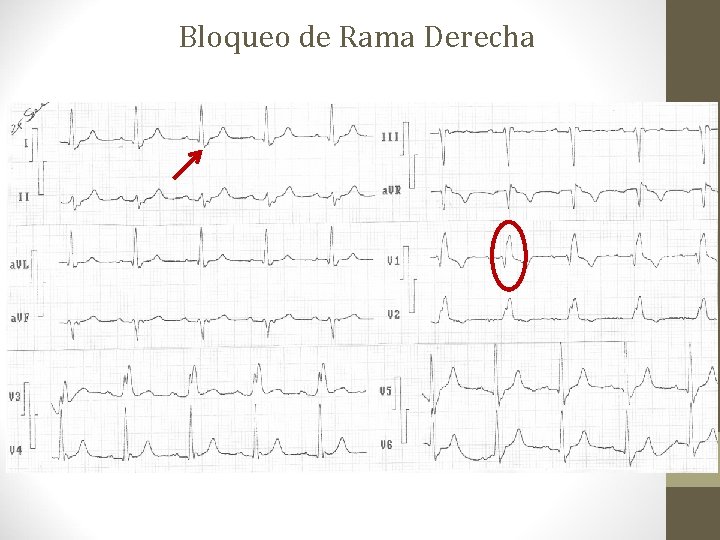 Bloqueo de Rama Derecha Bloqueo de Rama Derecha