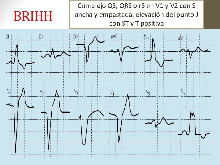 BRIHH V 5 Complejo y V 6: R ancha, QS, QRS en. Romeseta, r. BRIHH V 5 Complejo y V 6: R ancha, QS, QRS en. Romeseta, r.