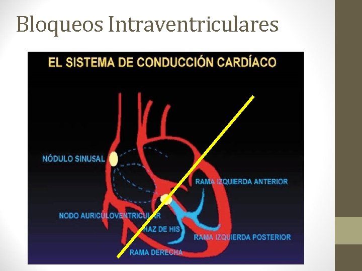 Bloqueos Intraventriculares Bloqueos Intraventriculares