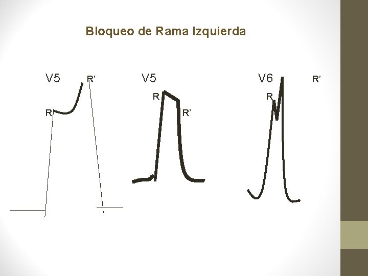 Bloqueo de Rama Izquierda V 5 R R’ V 5 V 6 R R Bloqueo de Rama Izquierda V 5 R R’ V 5 V 6 R R