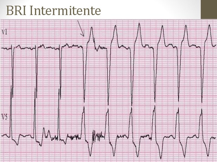 BRI Intermitente BRI Intermitente